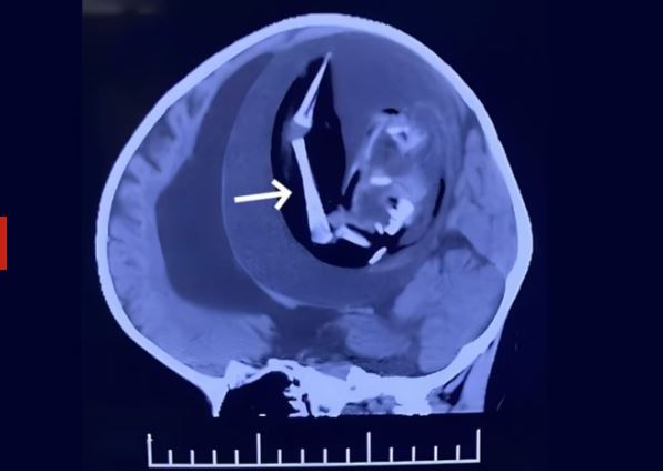 Médicos encontram braço em crânio de bebê que demorou a desenvolver fala