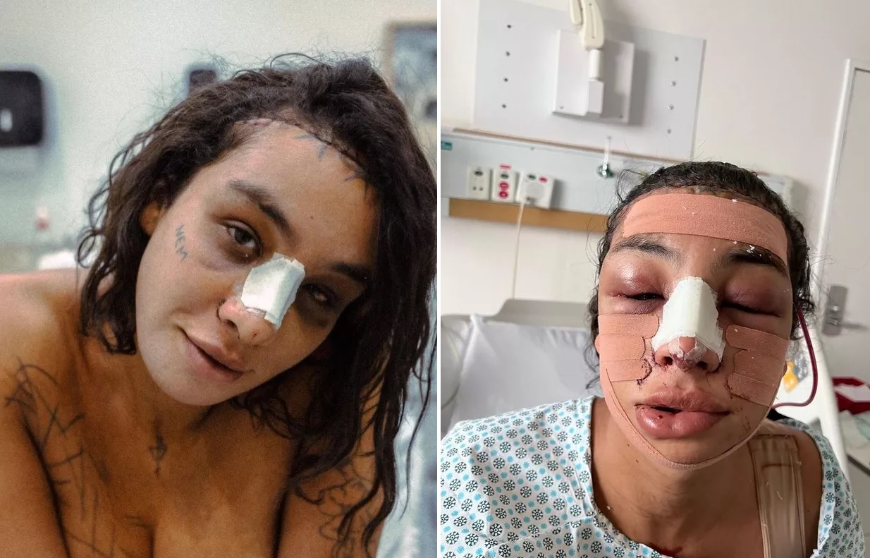 Ex-BBB Linn da Quebrada faz cirurgia de feminilização no rosto