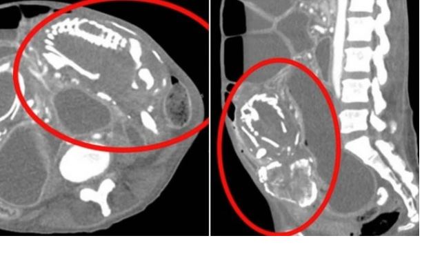 Mulher culpa bruxa antes de morrer por gerar bebê de pedra