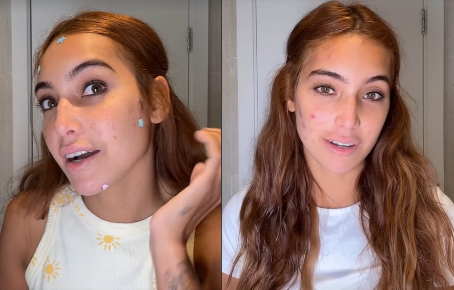 Vanessa Lopes mostra resultado de tratamento contra acne 