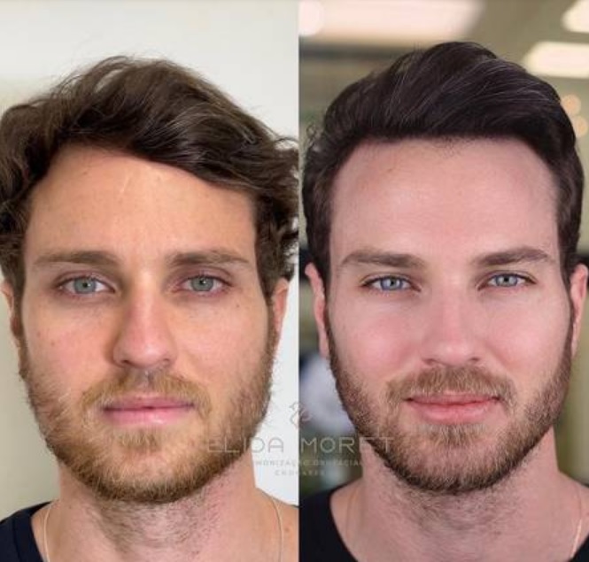 Ex-BBB Lucas Bissoli faz harmonização facial; veja o resultado