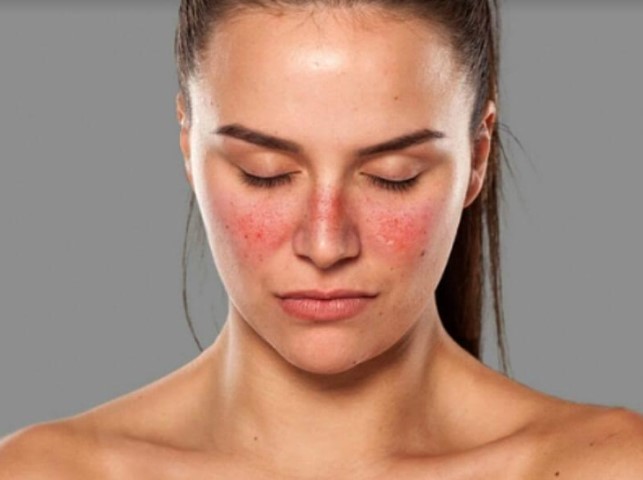 Reumatologista explica como ocorre a doença do lúpus e principais sintomas