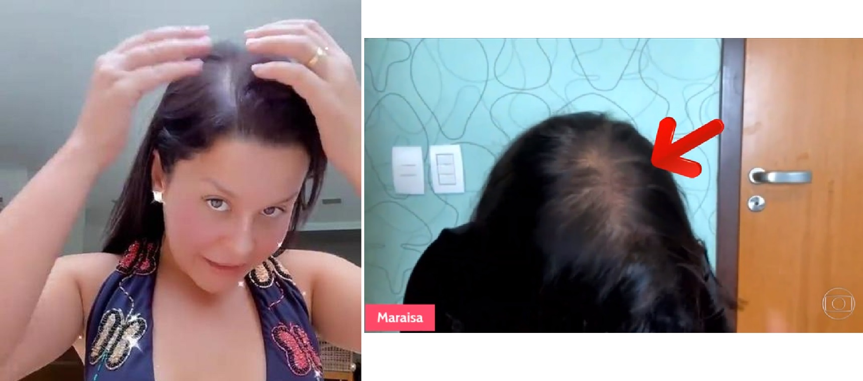 Maraisa fala sobre calvície feminina: 'é muito comum'