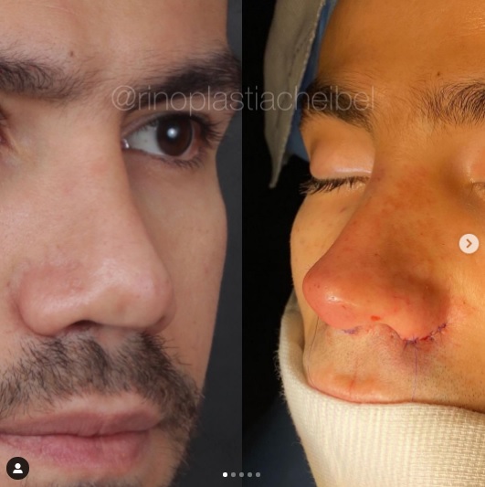 Sertanejo Mariano mostra antes e depois de 5ª cirurgia no nariz e choca fãs