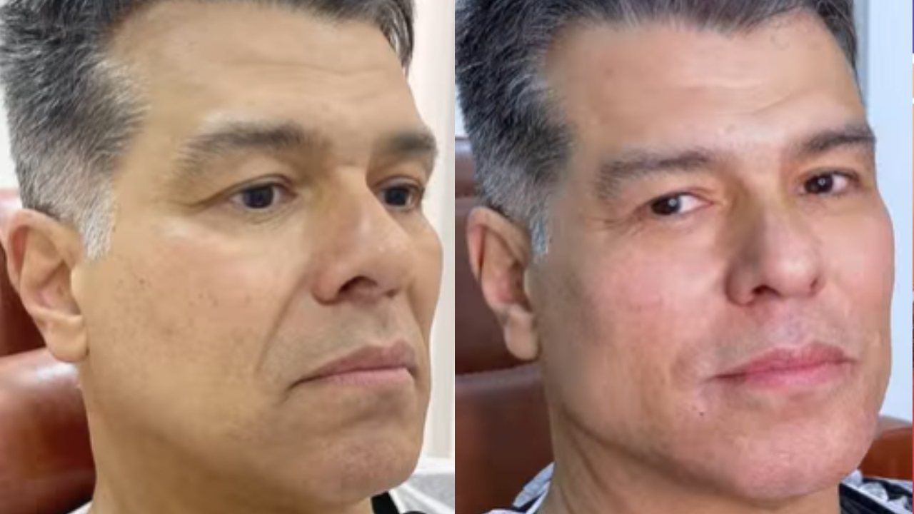 Maurício Mattar faz harmonização facial; veja antes e depois
