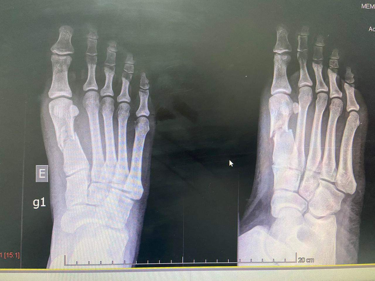 Mulher tem pé quebrado com golpes de capacete pelo ex-namorado 