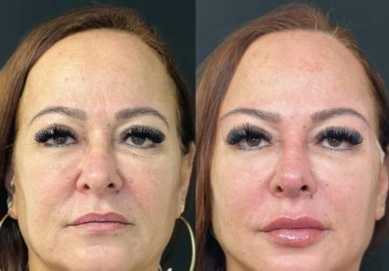 Mãe de Neymar faz recauchutagem no rosto; veja antes e depois