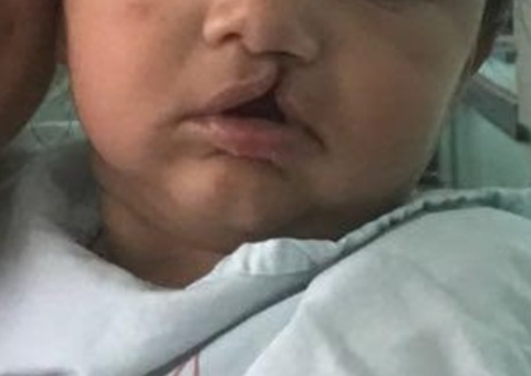 Hospital em Manaus começa triagem para cirurgias de lábio leporino