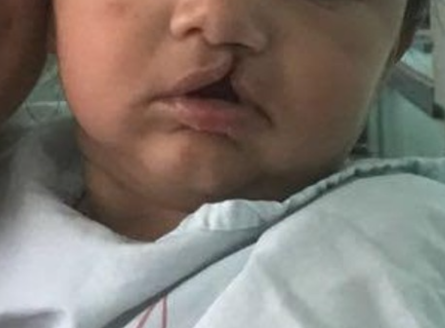 Hospital em Manaus começa triagem para cirurgias de lábio leporino