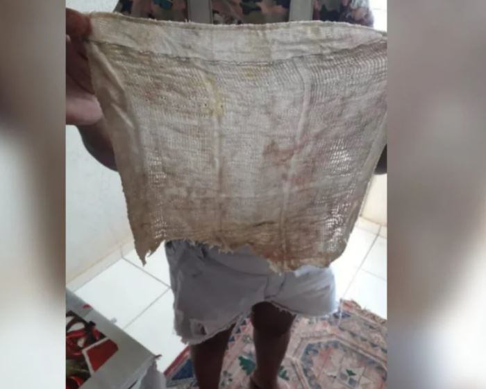 Após meses de dor, mulher descobre pano no ânus esquecido durante cesárea