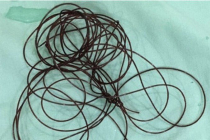 Homem vai parar no hospital após enfiar fio de nylon no pênis 