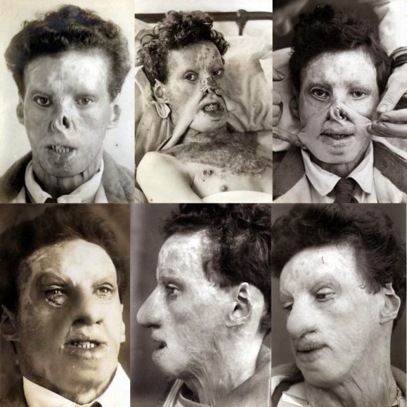 Cirurgias plásticas foram criadas para atender soldados feridos em guerra