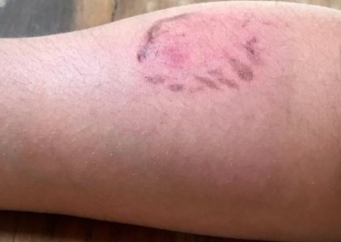 Jovem é agredida com mordidas e choque ao tentar terminar relacionamento