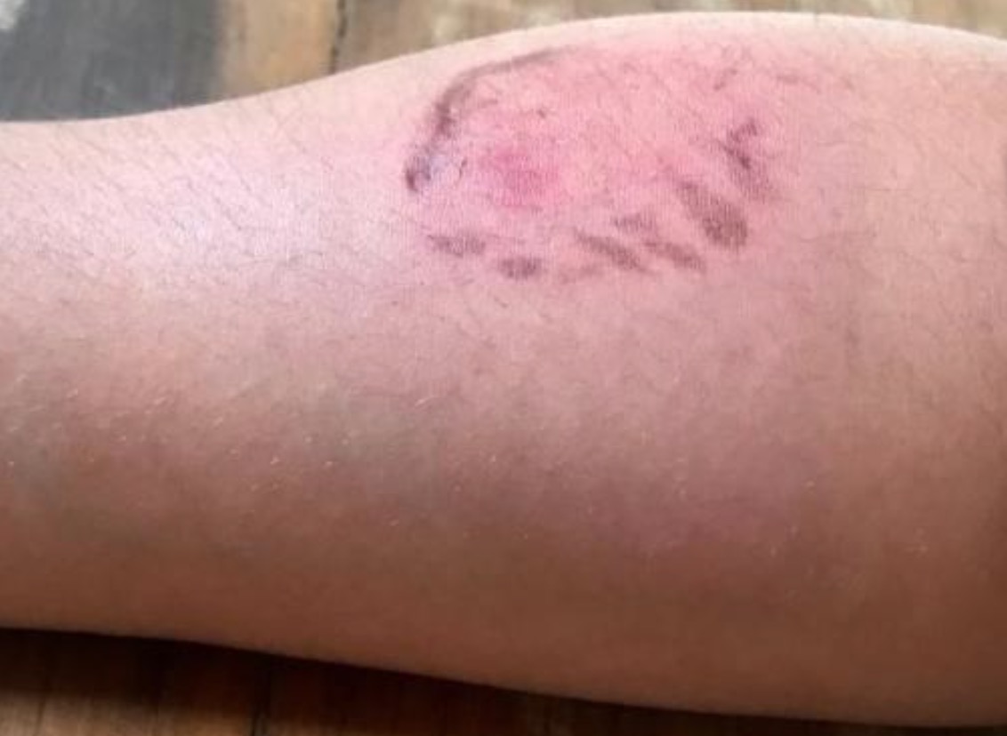 Jovem é agredida com mordidas e choque ao tentar terminar relacionamento