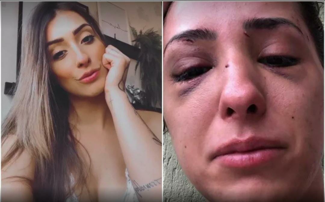 Modelo fica com rosto deformado ao ser espancada por terminar namoro