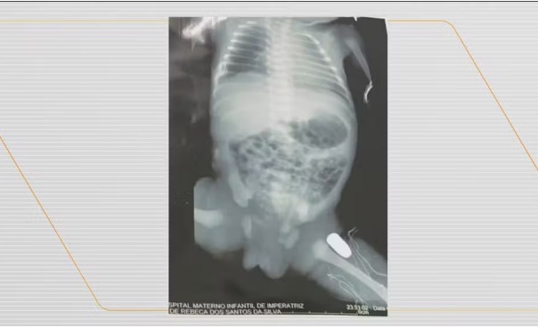 Bebê passa por cirurgia após ser baleada dentro da barriga da mãe