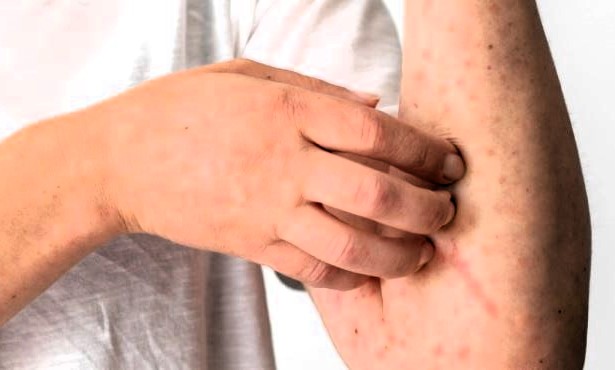 Oropouche: Amazonas apresenta redução de casos seguida de estabilidade da doença