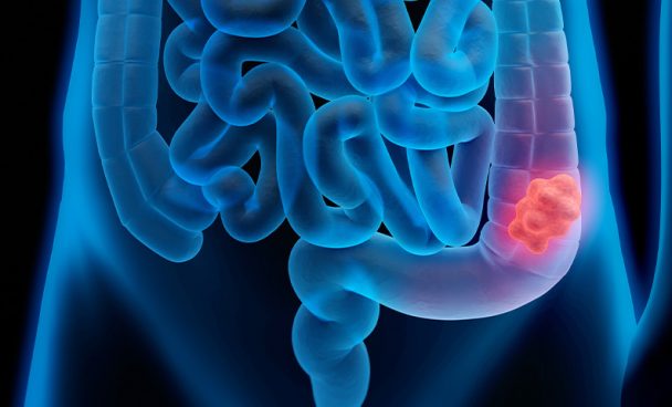 Câncer colorretal é o 3° que mais mata no mundo; Veja maus hábitos que levam à doença