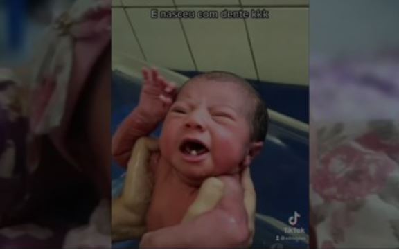 Bebê surpreende ao nascer com 2 dentes no Pará