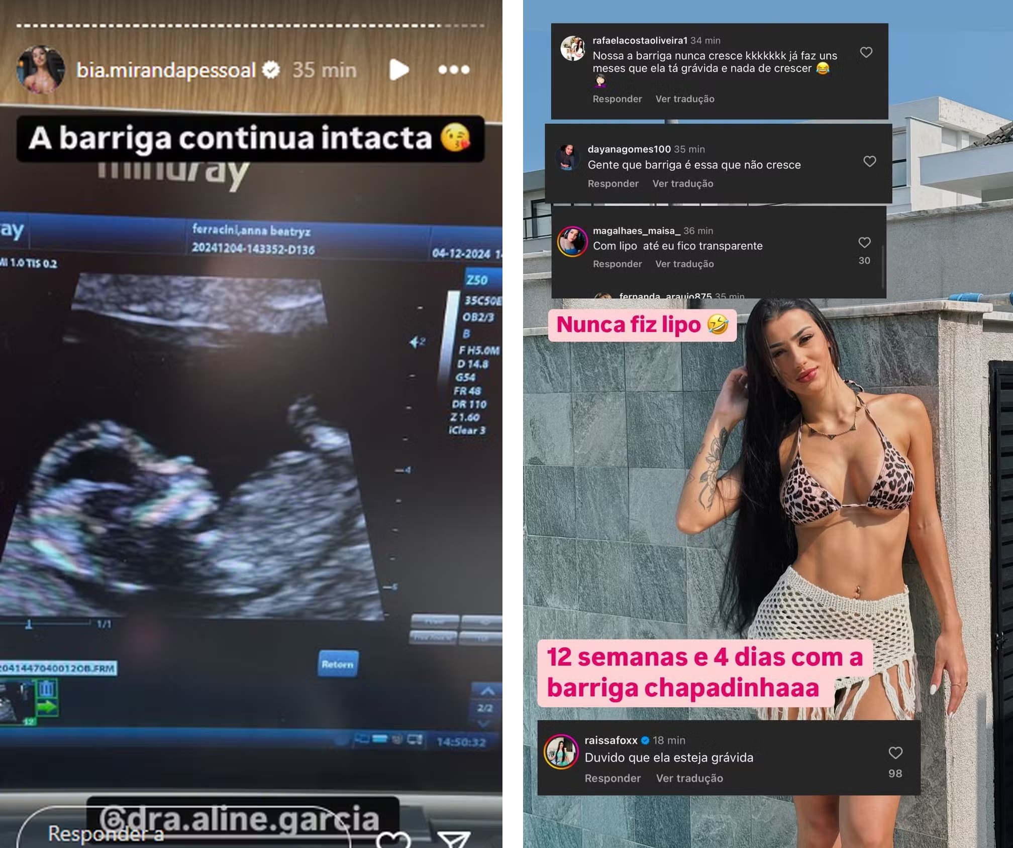 Com barriga chapada, Bia Miranda mostra ultrassom para provar gravidez