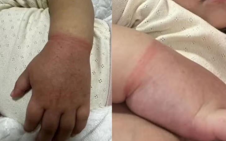 Menina de 2 anos quase perde o braço em Manaus por elástico de cabelo