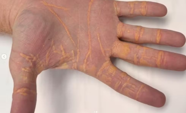 Colesterol 'vaza' pelas mãos de homem após aderir a dieta carnívora