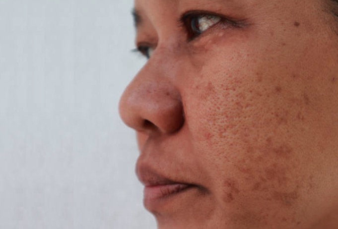 Manchas de melasma na pele tem cura? Saiba mais