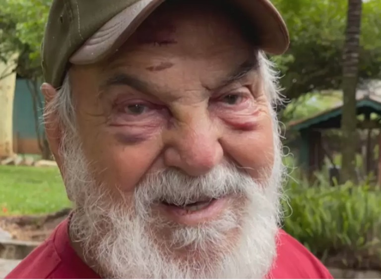 Aos 91, Lima Duarte surge com os olhos roxos após tombo 