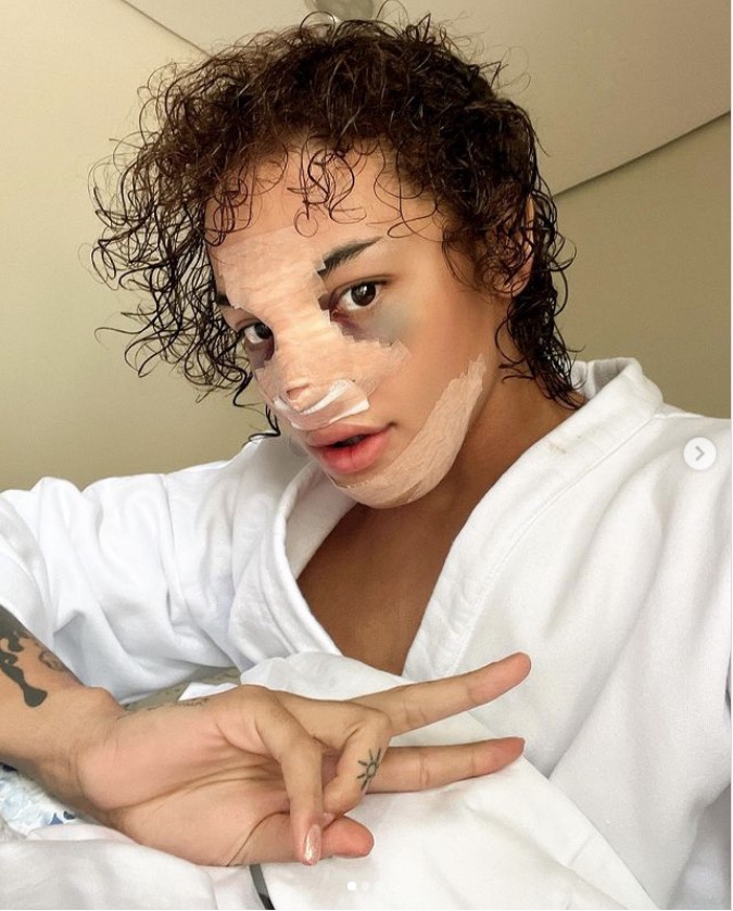 Pabllo Vittar surge com rosto irreconhecível após cirurgia plástica 