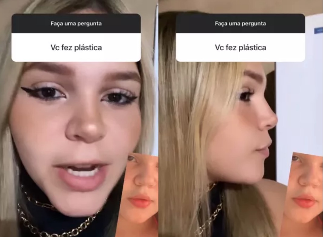 Filha de Simony, Aysha Benelli mostra antes e depois de cirurgia plástica no nariz