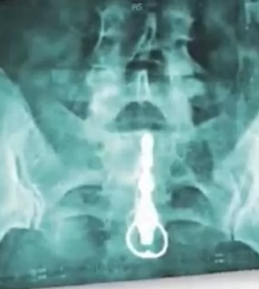 Mulher vai parar na emergência após vibrador ficar preso no ânus 