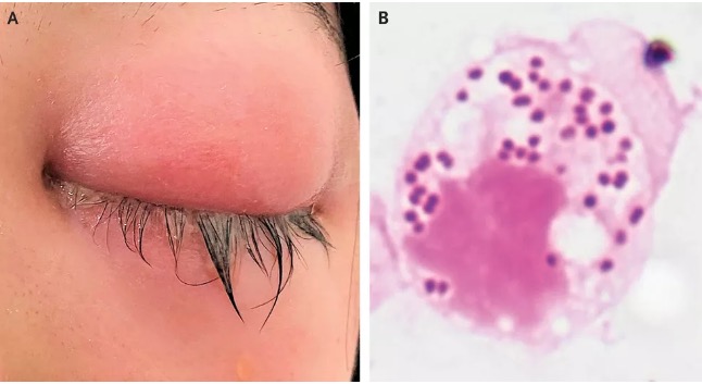 Infecção sexualmente transmissível causa conjuntivite que pode levar a cegueira
