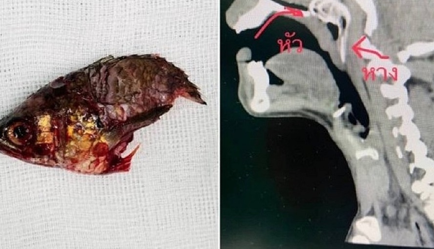 Peixe pula na boca de pescador e fica entalado na garganta do homem