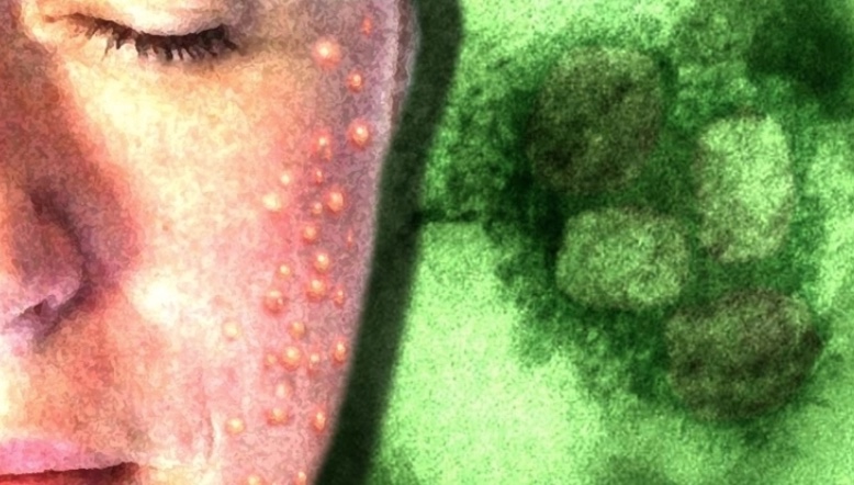 Casos de varíola dos macacos sobem para 21 no Brasil