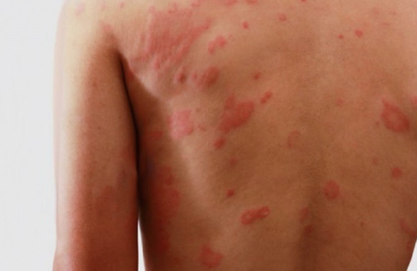 Com 51 de casos novos de hanseníase em Manaus, Semsa orienta sobre autoexame