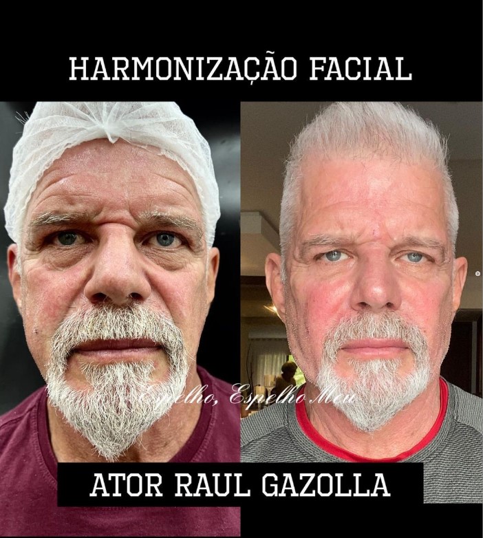 Raul Gazolla arranca elogios de fãs ao mostrar antes e depois de harmonização facial; confira