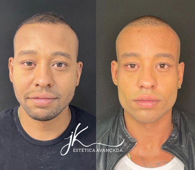 Mussunzinho impressiona ao mostrar antes e depois de harmonização facial