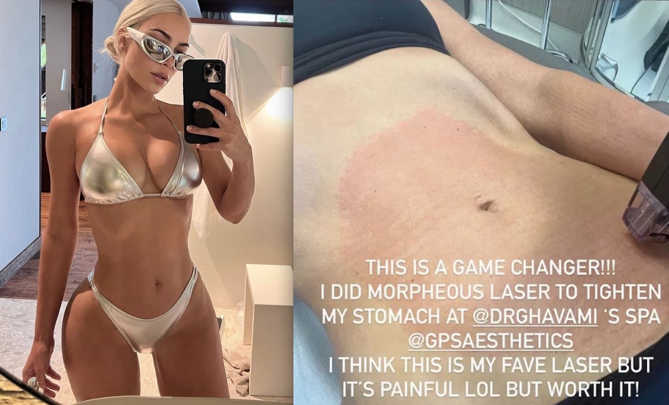Kim Kardashian mostra tratamento estético a laser para apertar barriga 