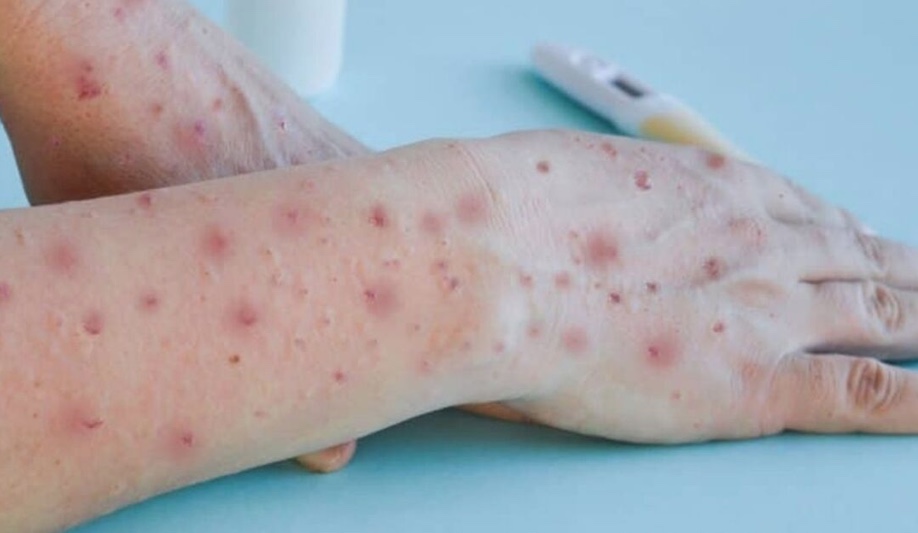 Sobe para 8 número de casos suspeitos de Varíola dos Macacos no Amazonas