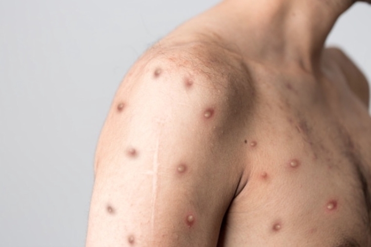 Sobe para 30 número de infectados com Varíola dos Macacos no Amazonas