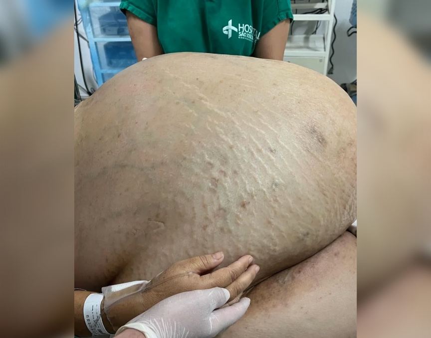 Tumor de 46kg é retirado de mulher em cirurgia de emergência no Brasil