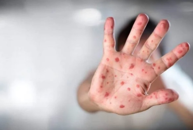 Semsa e FVS discutem plano para interromper casos de sarampo em Manaus