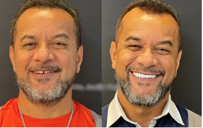 Homem morre após ter infecção depois de colocar facetas dentárias, diz família