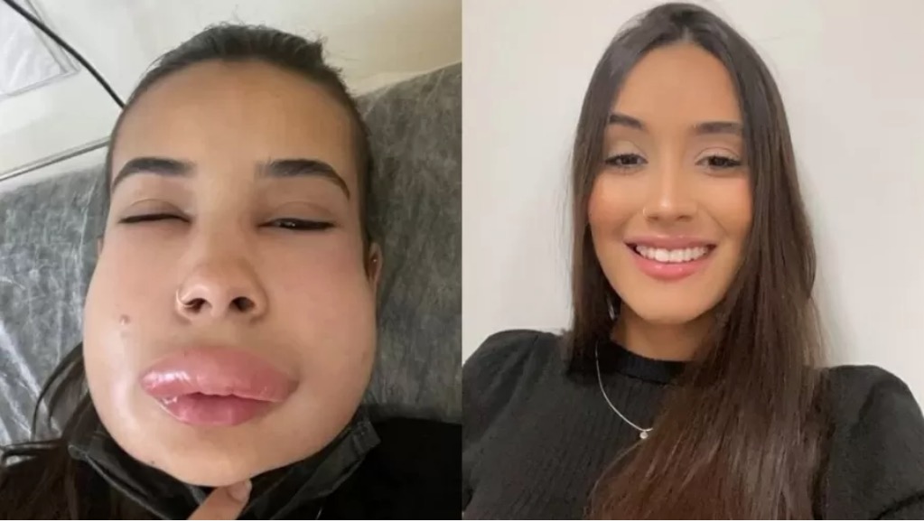 Jovem fica com rosto irreconhecível após reação alérgica em procedimento estético
