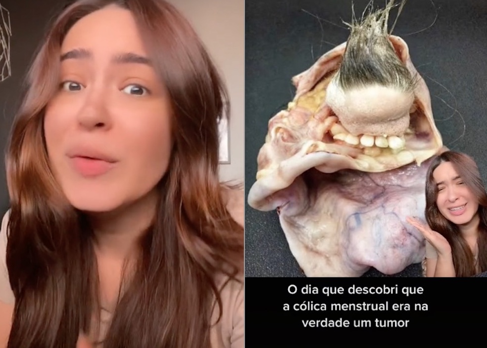 Advogada choca ao dizer que descobriu tumor no ovário com cabelo e dentes 