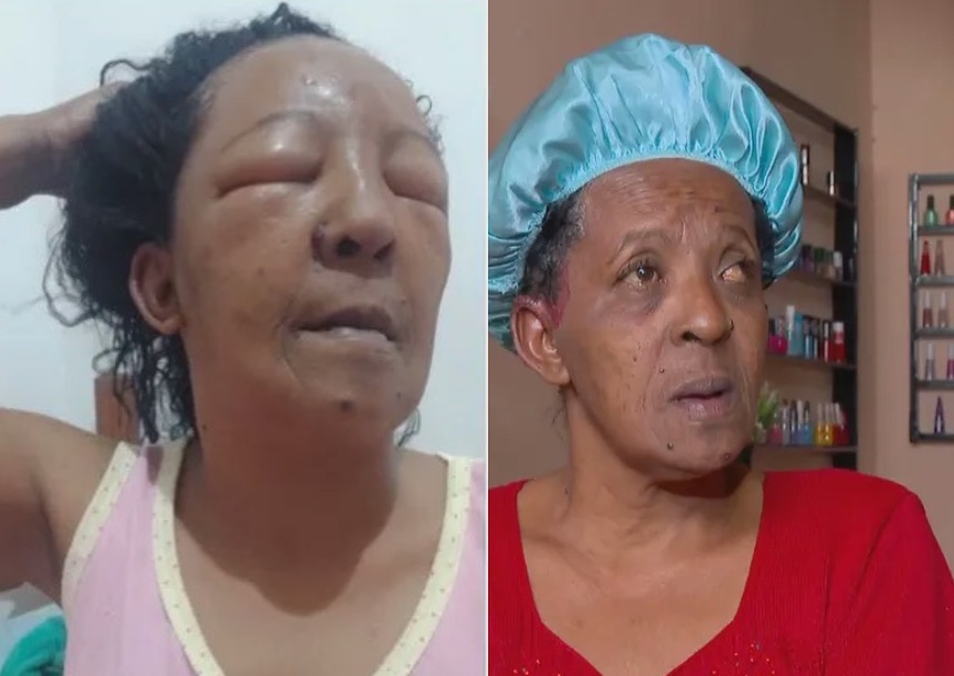 Irreconhecível, mulher fica sem abrir os olhos após ter alergia a relaxamento capilar