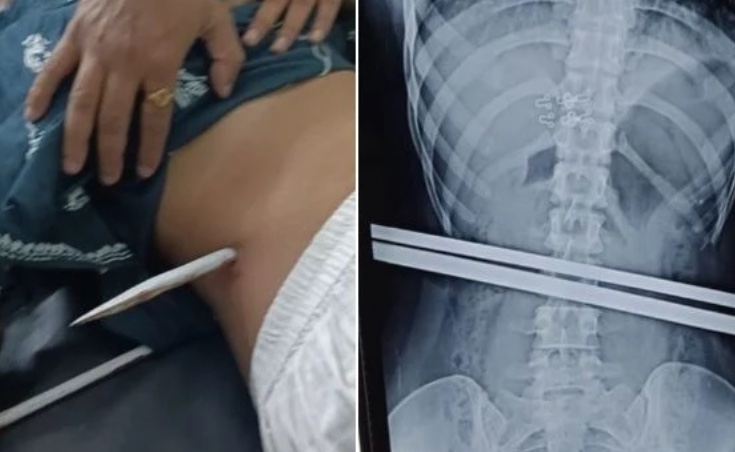 Mulher tenta fugir de macacos e é perfurada por barra de ferro