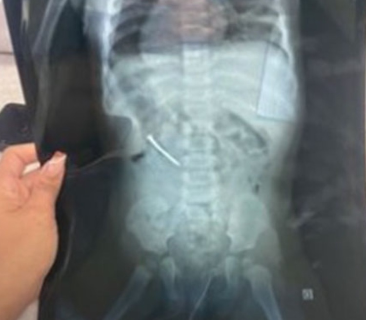 Menina de um ano é internada após engolir prego no dia do aniversário no Pará