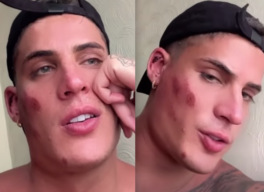 Com rosto machucado, ex-A Fazenda Tiago Ramos explica briga em praia  