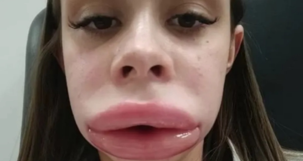 Jovem fica com rosto inchado após preenchimento labial e descobre doença rara